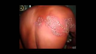 preview picture of video 'trypophobia skin disease'