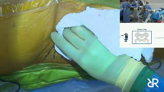 Dr. Stefan Kreuzer performs Total Hip Arthroplasty using @IntellijointSurgical (Anterior Approach)