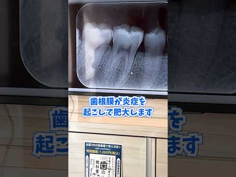 歯の痛みがあるけど虫歯がない時って？ #shorts #歯医者 #歯科衛生士 #たぼ歯科 #さいたま市 #浦和 #虫歯