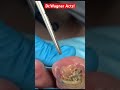 DRAINAGE OF HUGE ABSCESS🤯Part 2/2#shorts