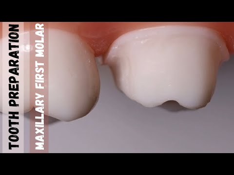 Maxillary First Molar | Tooth Preparation for PFM | Step by Step Demonstration