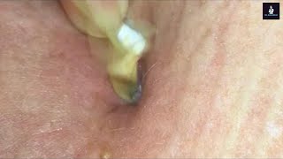 Pus Plug Burst Infected Belly Button By DR Blackhe