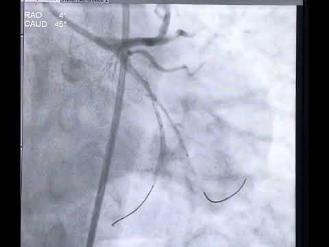 Case 9:- Bifurcation stenting of LCX-OM1 by nano-crush technique