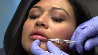 preview picture of video 'Subtle Natural Lip Enhancement with Restylane Chevy Chase Maryland'