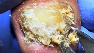 Onychomycosis Is Like Teeth, Perfect Trimming Process【Xue Yidao】