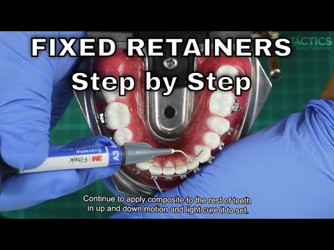Fixed Retainer Step by Step