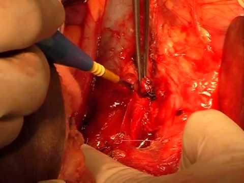 Open Para Aortic Lymphadenectomy
