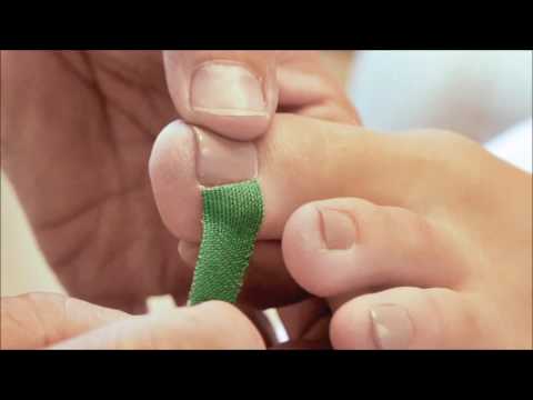 Laboruntersuchung des Urins bei Diabetes Essen erlaubt bei Diabetes