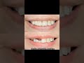 Digital Peek Dentures