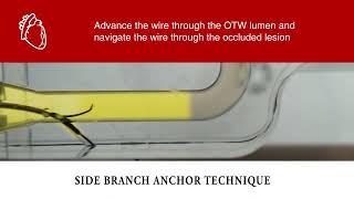 Side Branch Anchor: Dual-Lumen Catheter Tutorial