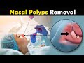 Nasal Polyps and their treatment  | How Polypectomy is Performed? (Urdu/Hindi)