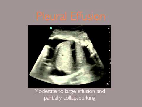 Pleural Effusion Ultrasound Sonoguide