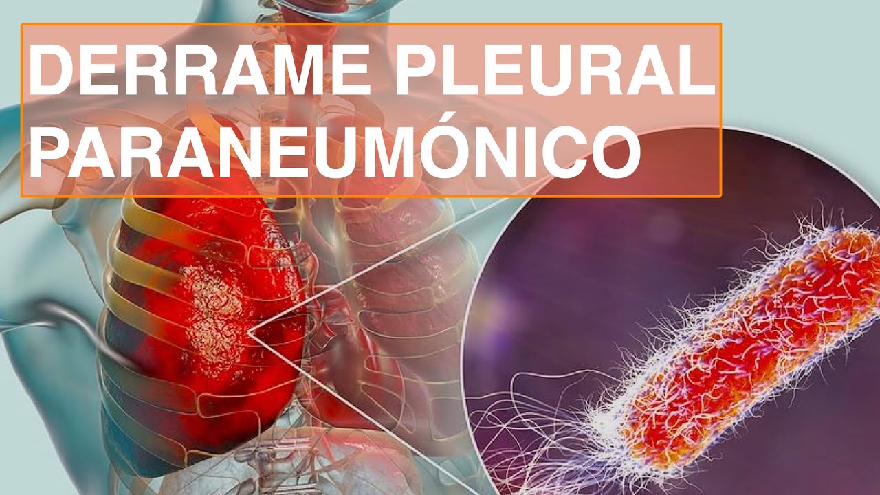 Derrame Pleural Paraneumónico
