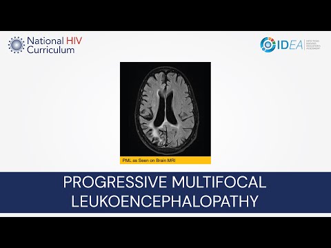 Mini-Lecture Series: Progressive Multifocal Leukoencephalopathy (PML)