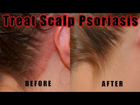 Does psoriasis get better with age