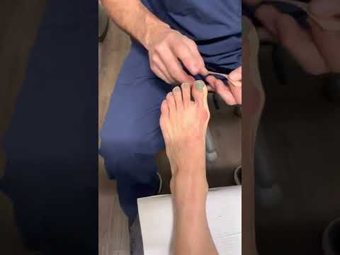 Corrective Bunion Taping