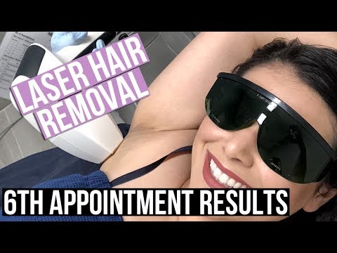 FINAL LASER HAIR REMOVAL RESULTS AFTER 6TH TREATMENT...