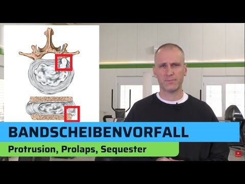 Bandscheibenvorfall - Schäden der Bandscheibe einfach erklärt