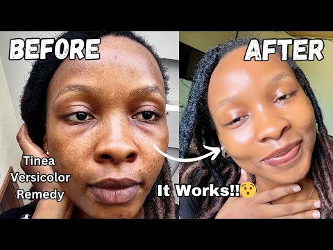 How I Cleared My Tinea Versicolor In Just 1 Week (The only Product that works)