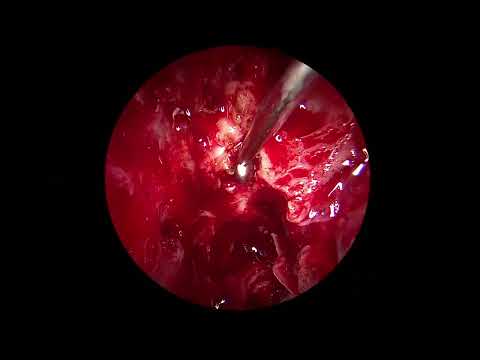 ENDOSCOPIC ENDONASAL CSF LEAK REPAIR