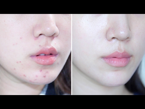 How To Get Rid Of Acne Naturally | Skin Transformation ❤ Liah Yoo Video