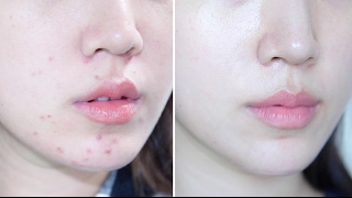 How To Get Rid Of Acne Naturally | Skin Transformation ❤ Liah Yoo