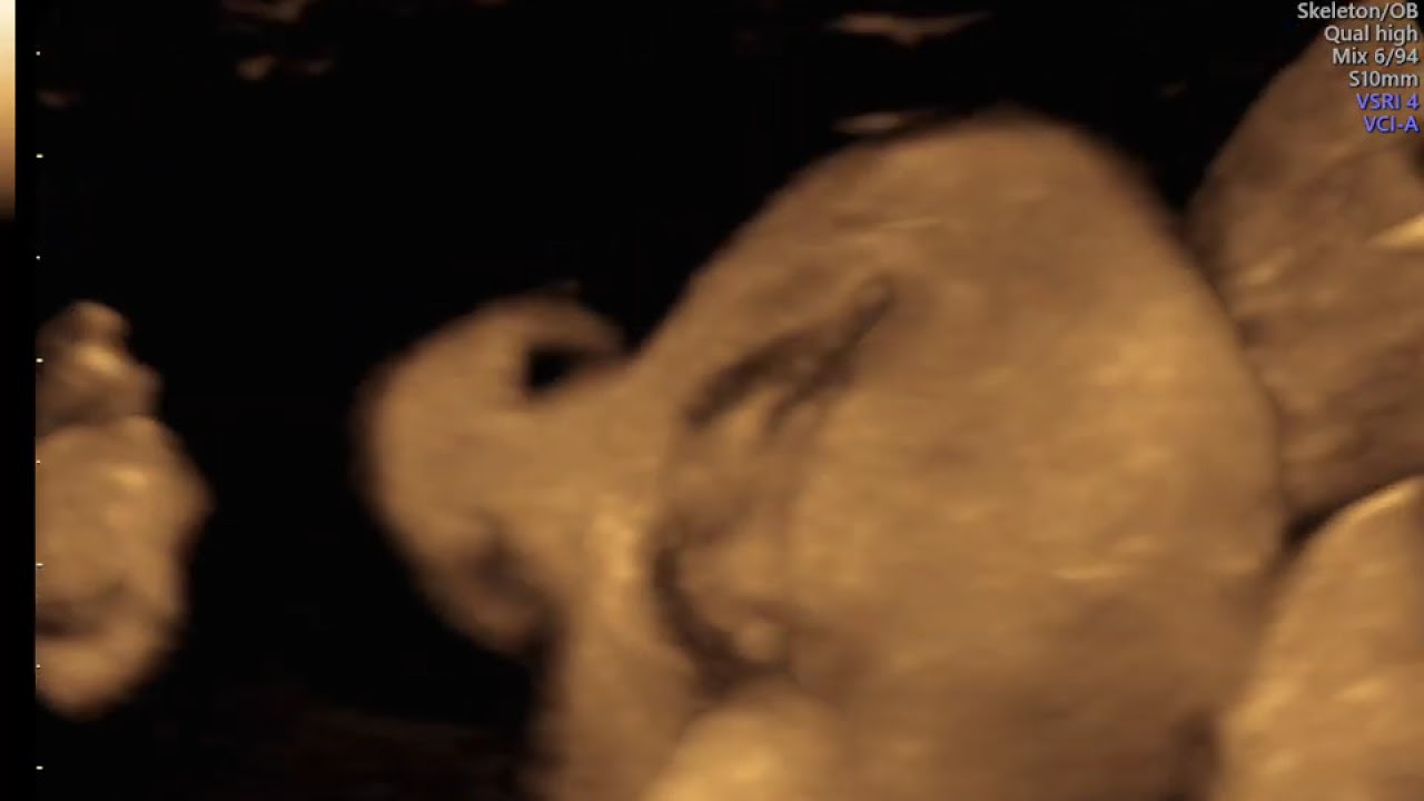 AVALIAÇÃO  E BOCA NARIZ E LABIOS EM ECOGRAFIA MORFOLÓGICA