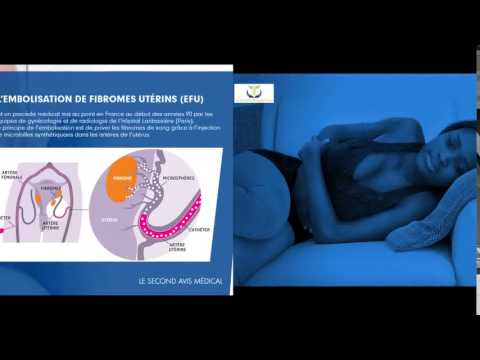 Adénoïde et la pression artérielle Médicaments du bruit dans ma tête pour lhypertension