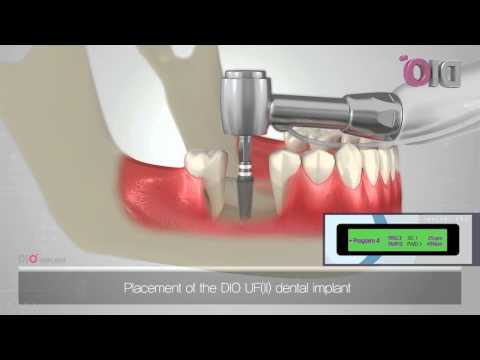 YouTube video about: How do teeth implants work?