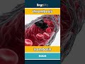 thrombosis - trombosis video thumbnail