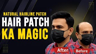 Baal Wapas Paayein 1 Ghante Mein | Rizy Hair Solution | Best Hair Patch Centre | 9599858612