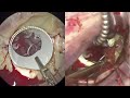 Step by stepTransaxillary direct view MVR