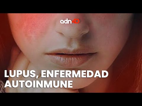 Lupus la enfermedad autoinmune que tiene mayor incidencia en mujeres