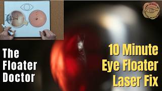 The 10 minute Eye Floater Fix - Laser Vitreolysis by The Floater Docto