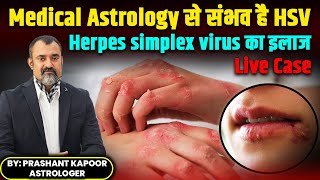 HSV Herpes Simplex Virus Treatment in Medical Astrology by | Prashant Kapoor