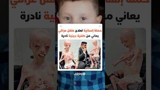 جعلت جسده بلا جلد يحميه.. حملة إنسانية لعلاج طفل عراقي يعاني من طفرة جينية نادرة thumbnail
