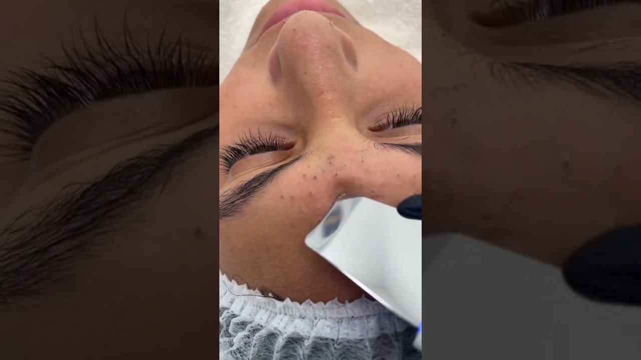 ACNE  SEVERE SUR LE FRONT ET EXTRACTION DIFFICILE #acne  #acnetreatment  #santé  #boutons  #femme