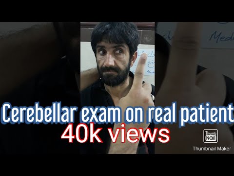 Cerebellum examination on real patient with cerebellar syndrome