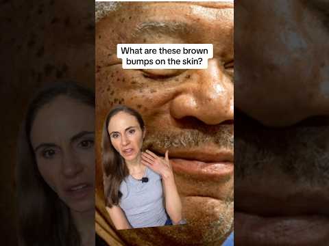 Why Do I Have All These Brown Bumps On My Face? #dermatologist