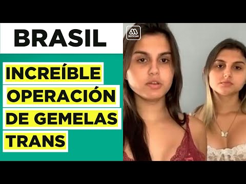 Brasil | Gemelas trans se operan juntas en cirugía de reasignación de sexo