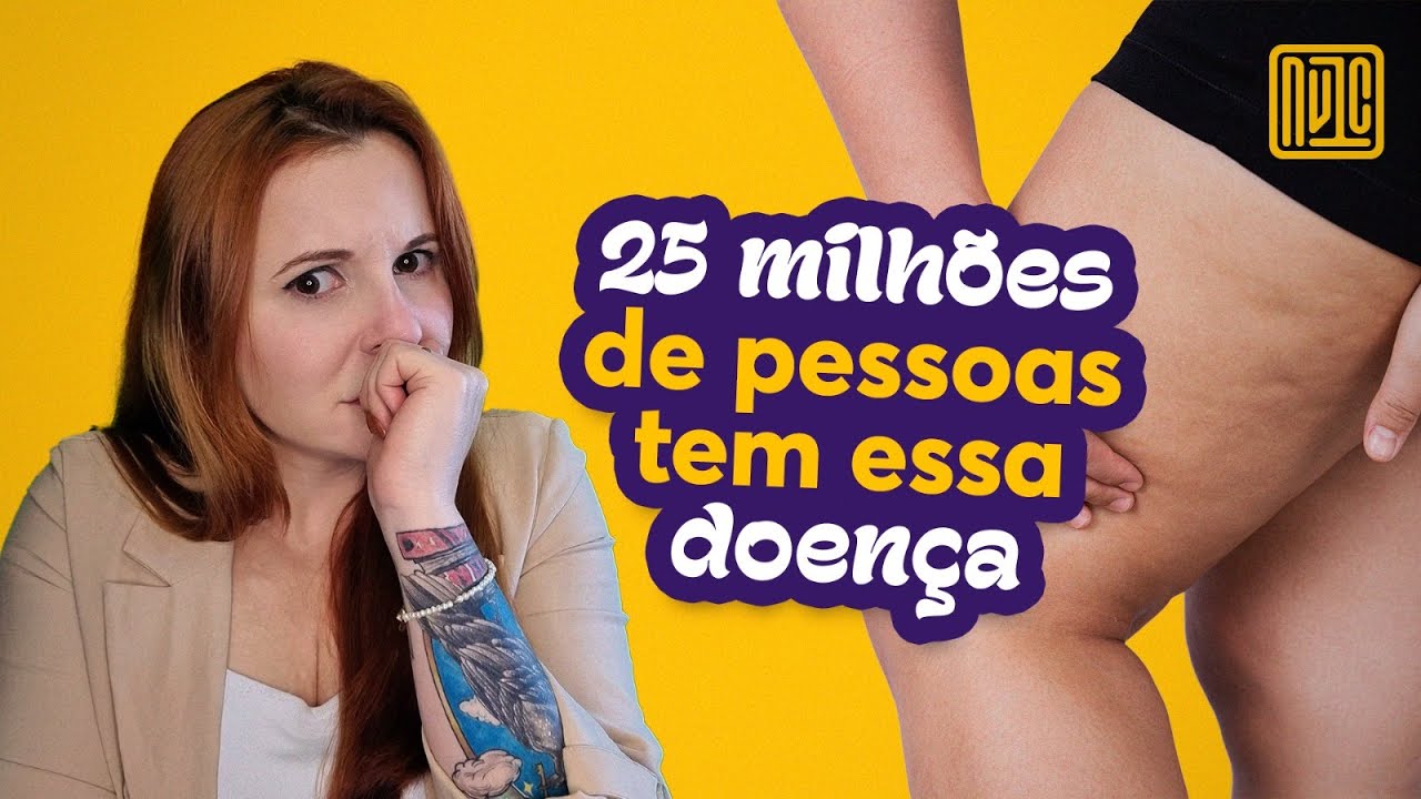 Como diagnosticar e tratar lipedema?