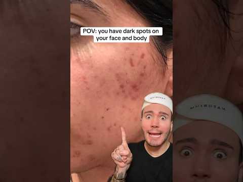 POV: VOCÊ TEM CICATRIZES DE ACNE!😱 (siga para mais!💗) #acne #beleza #dicasdebeleza #cuidadoscomapele #pele