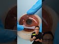 Corrigindo Miopia ‍ ️ Medicina Medico Oftalmologia Curiosidades Curiosidademedicina Saude