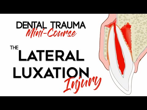 Dental Trauma Mini-Course - Part 9 - Dental Trauma Guide - The Lateral Luxation Injury