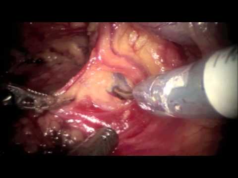 Robotic Surgery in Patients With Prior Pelvic Surgery