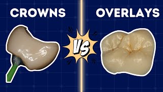 Onlays Vs Full Crowns - Decision Making 2024 - PDP189