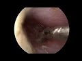 Ear tube placement (myringotomy)