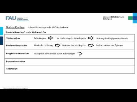 Ruptur des Kniemeniskus Ligamentum Schmerzen in den unteren Extremitäten Beingelenke