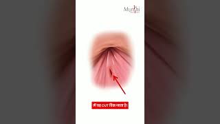 PPL Series Episode 3: Let's understand Anal Fissures today! #fissure #doctor #healthtips
