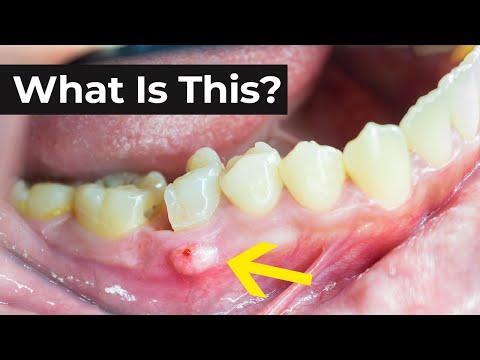 Abscess Tooth Face Swelling